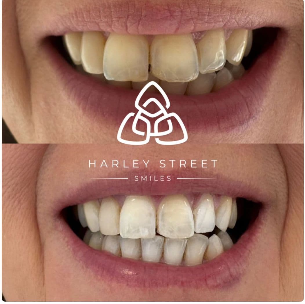Before and after teeth whitening at Clear Skin Radstock